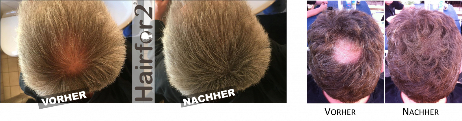 Hairfor2 Deutschland - Haarverdichtung + Haarauffüllung Hairfor2 - der  sensationelle Haarauffüller und Haarverdichter
